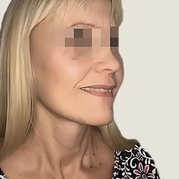 Después de Antes y después del lifting facial