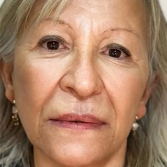 Después de Rejuvenecimiento facial
