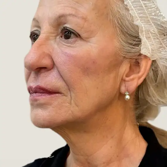 Después de Rejuvenecimiento facial