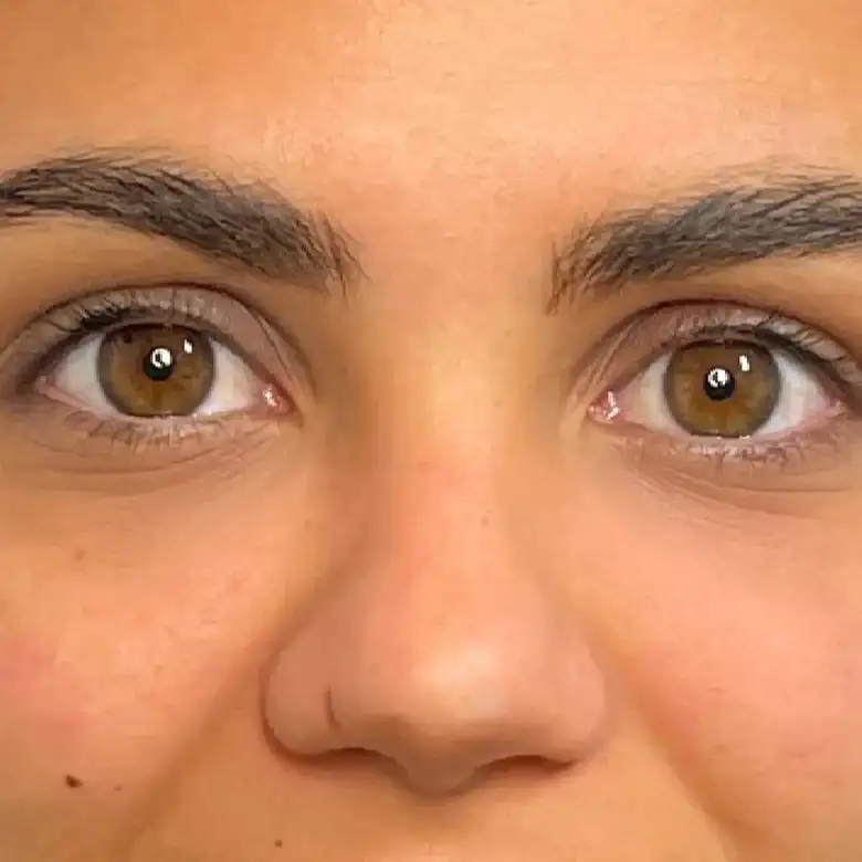 Después de Relleno de ojeras