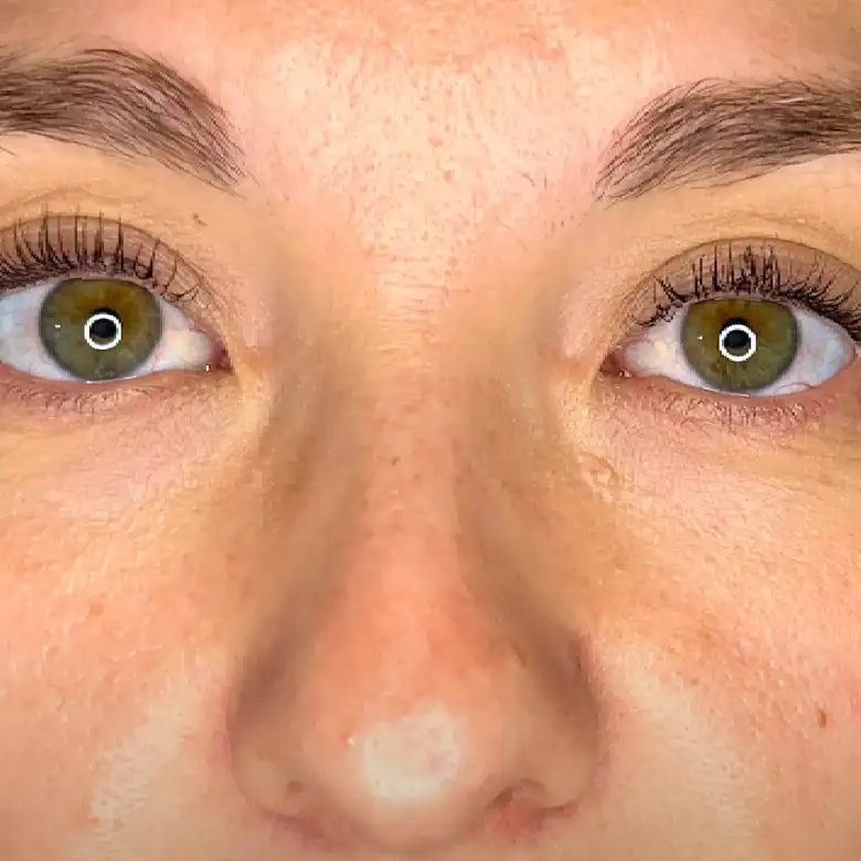 Después de Relleno de ojeras
