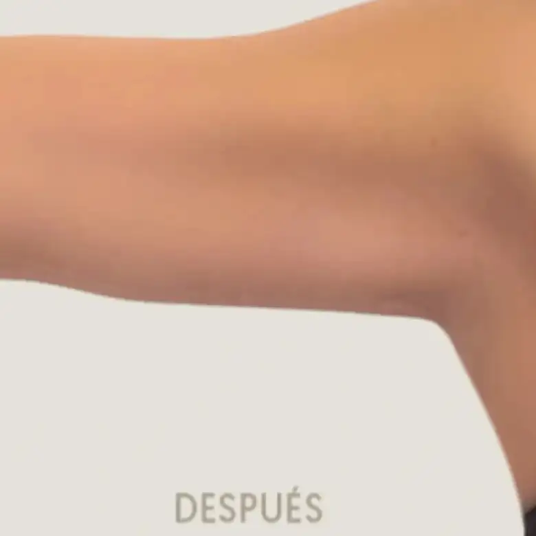 Después de Branquioplastia