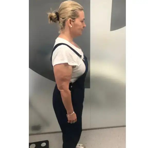 Después de Perdió 28kg