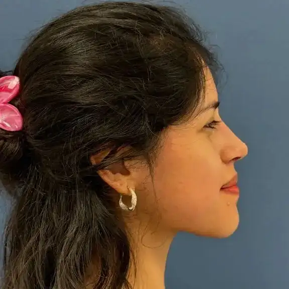 Después de Rinoplastia ultrasónica