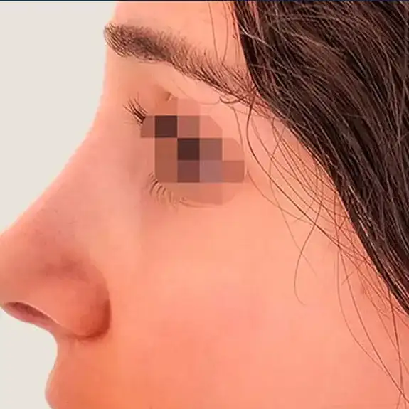 Después de Rinoplastia ultrasónica