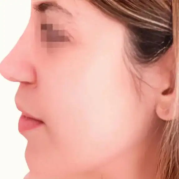 Después de Rinoplastia ultrasónica
