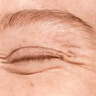 Eliminar arrugas de expresión: luce 10 años más joven