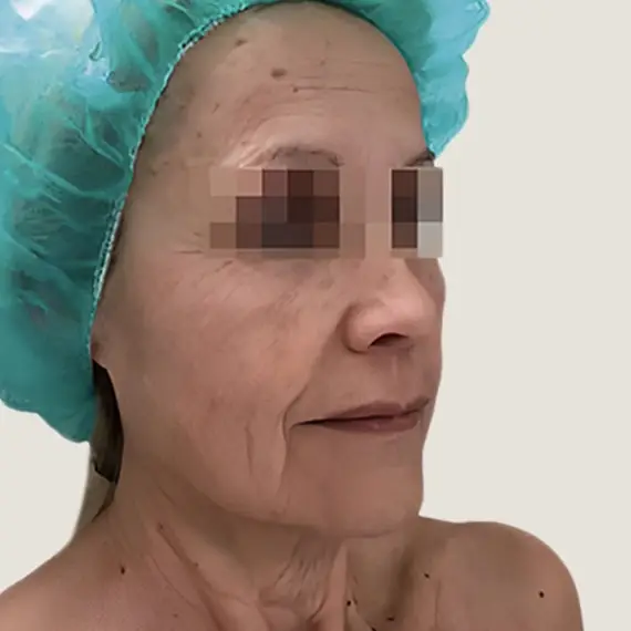Antes de Antes y después del lifting facial