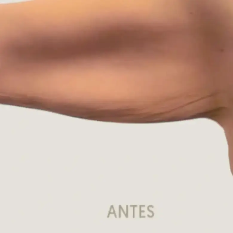 Antes de Branquioplastia
