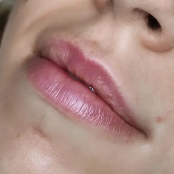 Antes de Relleno de labios
