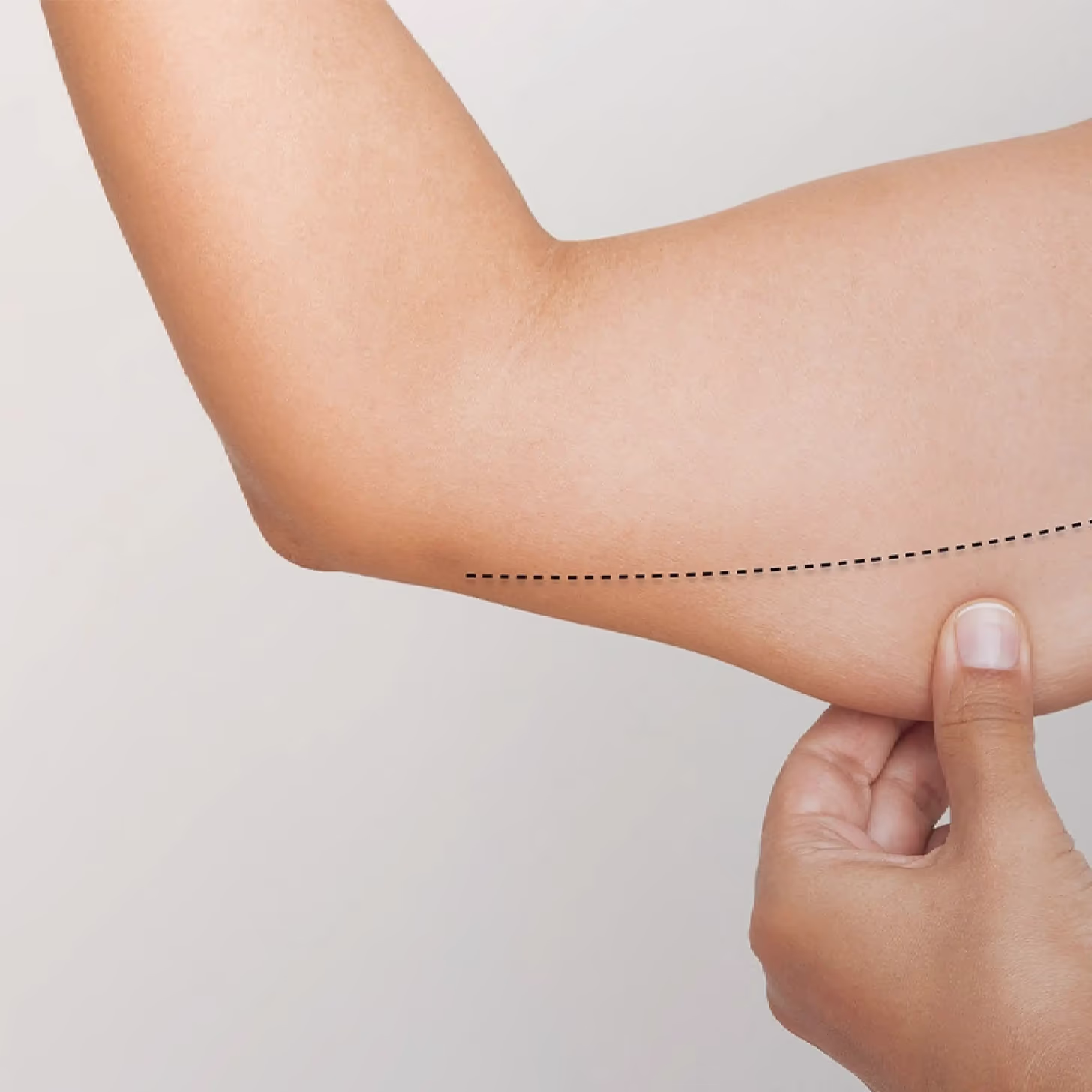 Paciente ideal para una braquioplastia