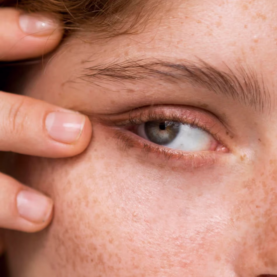 ¿Cómo se realiza el procedimiento de relleno de ojeras?