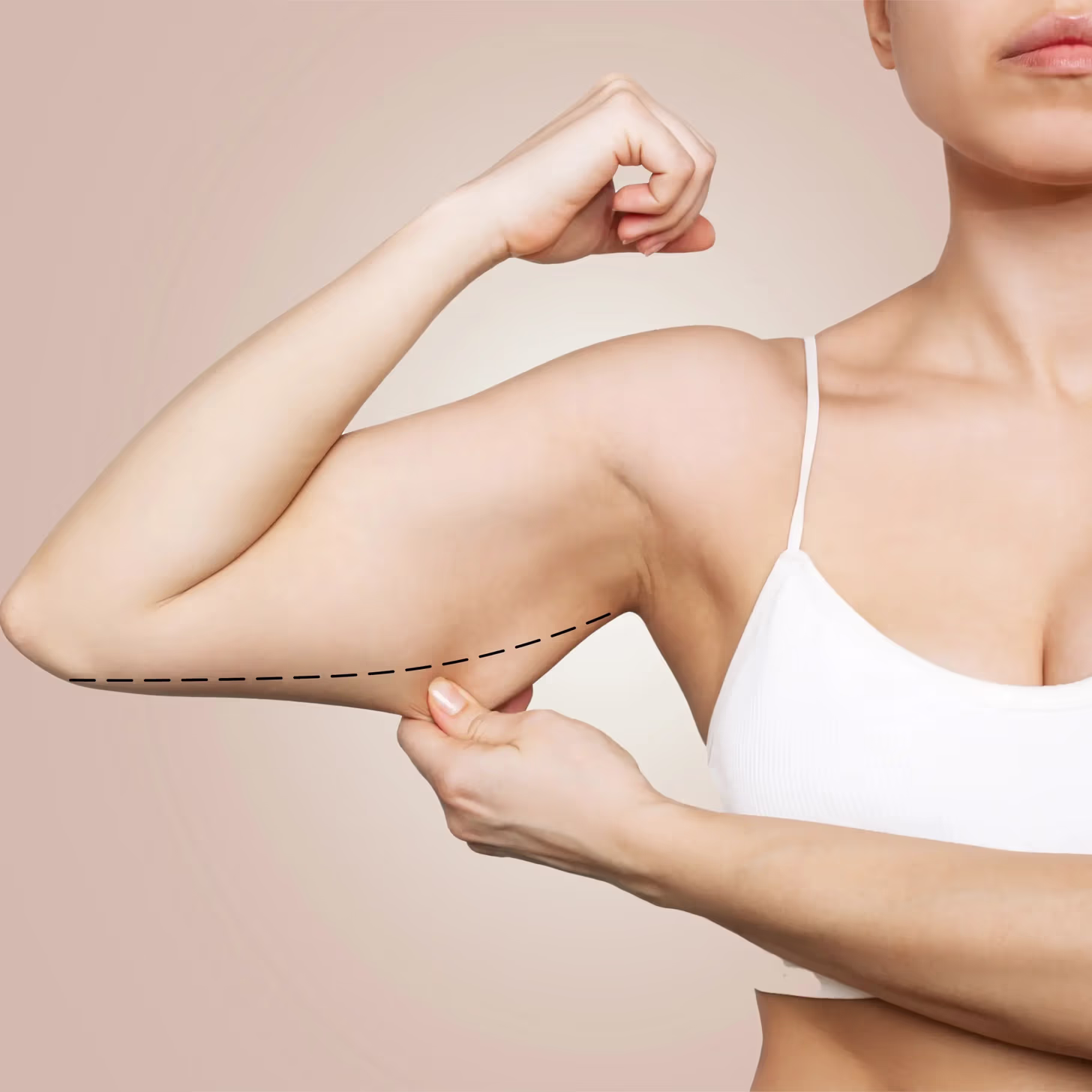 ¿Cómo se realiza el procedimiento de Lifting de brazos o braquioplastia?